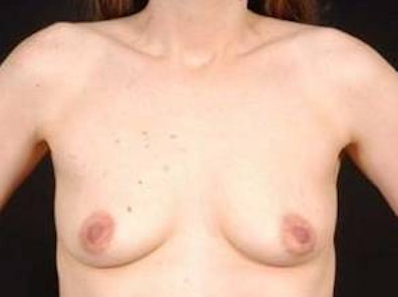 Breast Augmentation 410 Before & After Gallery - Patient 378964 - Image 1