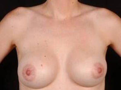 Breast Augmentation 410 Before & After Gallery - Patient 378964 - Image 2