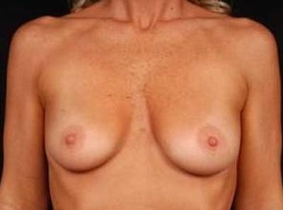 Breast Augmentation 410 Before & After Gallery - Patient 367594 - Image 1