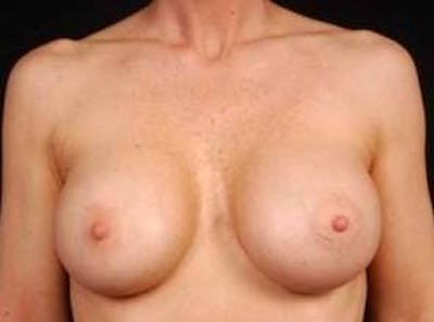 Breast Augmentation 410 Before & After Gallery - Patient 367594 - Image 2