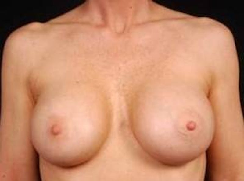 Breast Augmentation 410 Before & After Gallery - Patient 367594 - Image 2