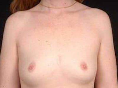 Breast Augmentation 410 Before & After Gallery - Patient 462614 - Image 1