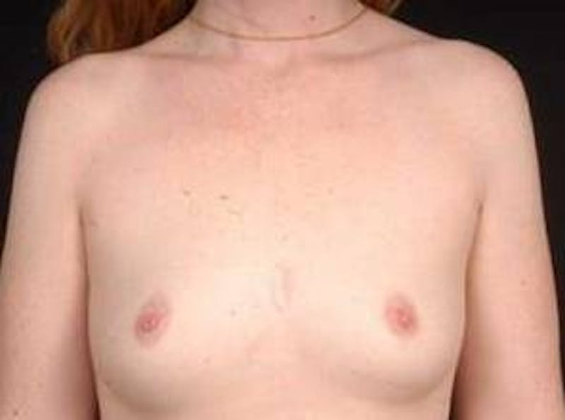 Breast Augmentation 410 Before & After Gallery - Patient 462614 - Image 1