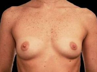 Breast Augmentation 410 Before & After Gallery - Patient 221414 - Image 1