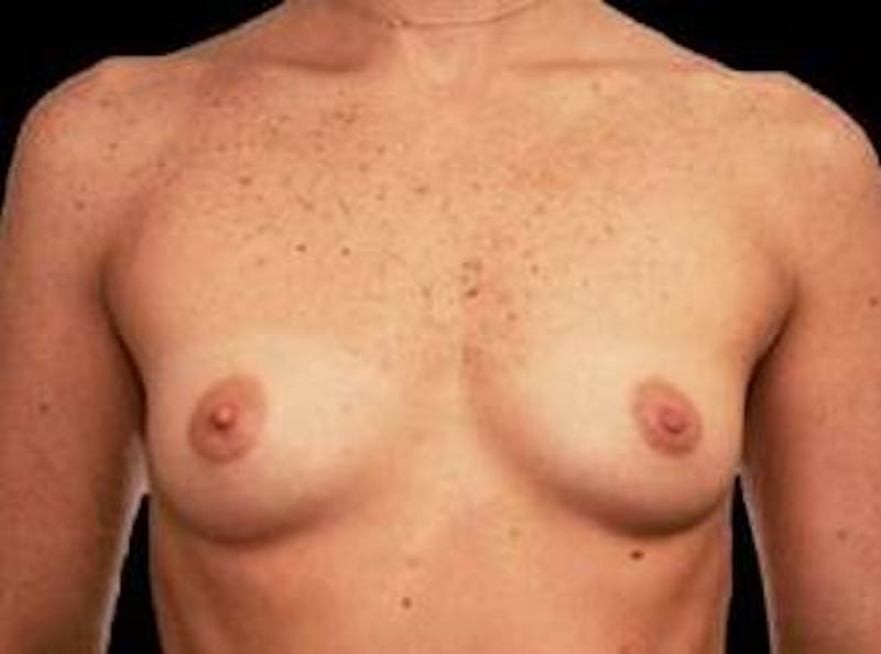 Breast Augmentation 410 Before & After Gallery - Patient 221414 - Image 1