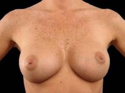 Breast Augmentation 410 Before & After Gallery - Patient 221414 - Image 2