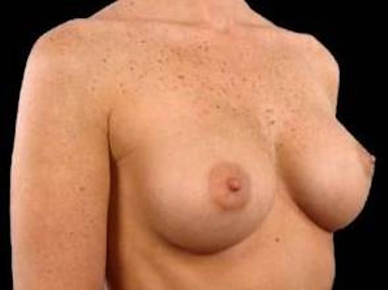 Breast Augmentation 410 Before & After Gallery - Patient 221414 - Image 4