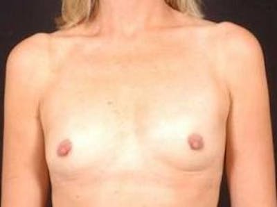 Breast Augmentation 410 Before & After Gallery - Patient 161384 - Image 1