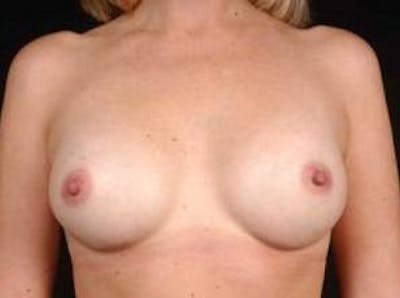 Breast Augmentation 410 Before & After Gallery - Patient 161384 - Image 2