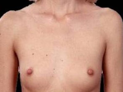 Breast Augmentation 410 Before & After Gallery - Patient 189801 - Image 1