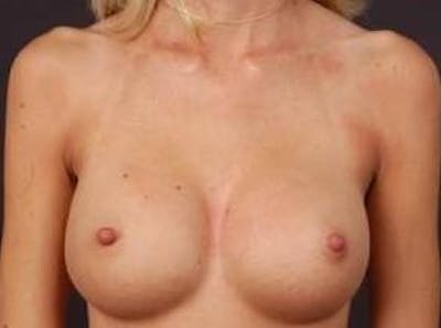 Breast Augmentation 410 Before & After Gallery - Patient 189801 - Image 2