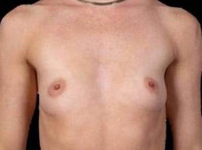 Breast Augmentation 410 Before & After Gallery - Patient 116907 - Image 1