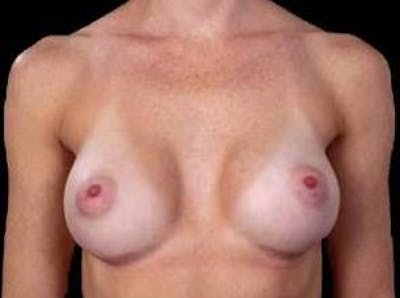 Breast Augmentation 410 Before & After Gallery - Patient 116907 - Image 2