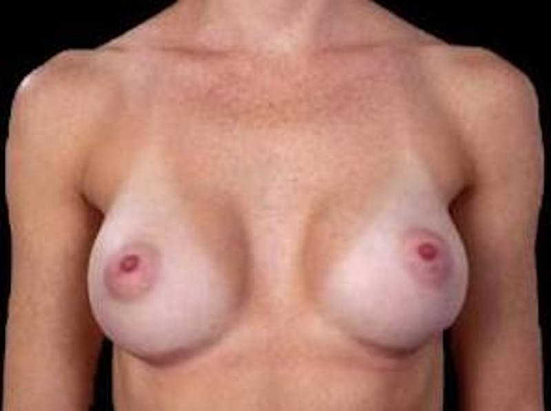Breast Augmentation 410 Before & After Gallery - Patient 116907 - Image 2