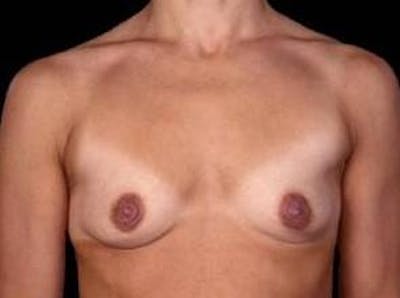 Breast Augmentation 410 Before & After Gallery - Patient 182789 - Image 1