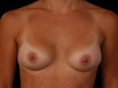 Breast Augmentation 410 Before & After Gallery - Patient 182789 - Image 2