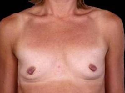 Breast Augmentation 410 Before & After Gallery - Patient 297519 - Image 1