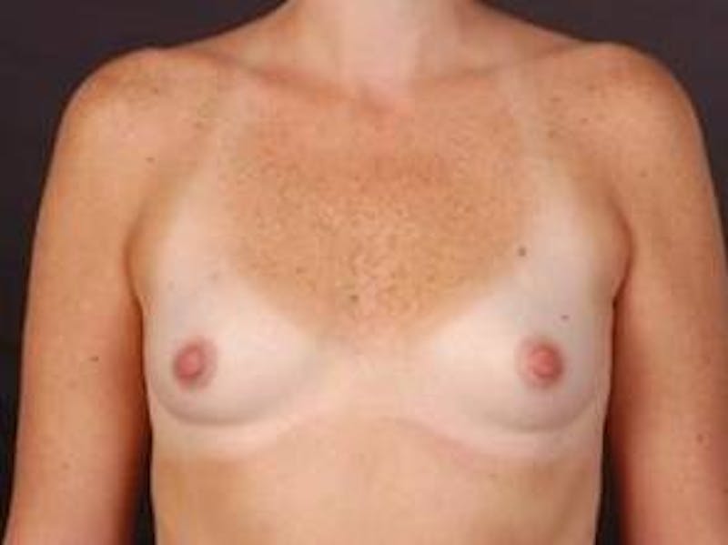 Breast Augmentation 410 Before & After Gallery - Patient 281973 - Image 1