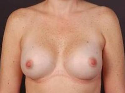 Breast Augmentation 410 Before & After Gallery - Patient 281973 - Image 2