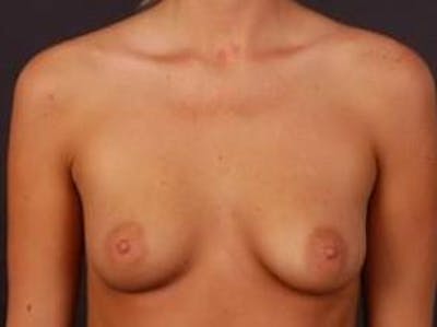 Breast Augmentation Saline Before & After Gallery - Patient 166773 - Image 1