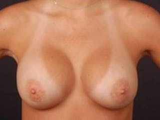 Breast Augmentation Saline Before & After Gallery - Patient 166773 - Image 2