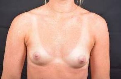 Breast Augmentation Silicone Gel Before & After Gallery - Patient 272417 - Image 1