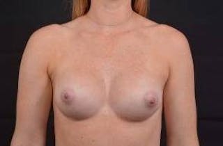 Breast Augmentation Silicone Gel Before & After Gallery - Patient 272417 - Image 2
