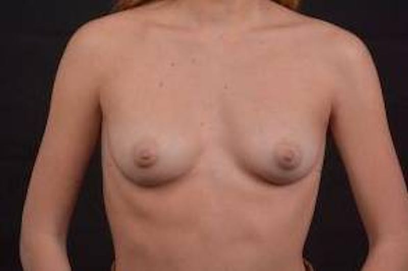 Breast Augmentation Silicone Gel Before & After Gallery - Patient 201394 - Image 1