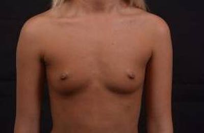 Breast Augmentation Silicone Gel Before & After Gallery - Patient 228658 - Image 1