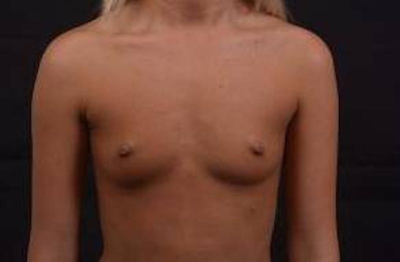 Breast Augmentation Silicone Gel Before & After Gallery - Patient 228658 - Image 1