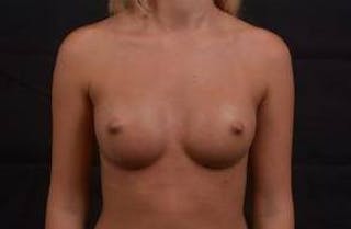 Breast Augmentation Silicone Gel Before & After Gallery - Patient 228658 - Image 2