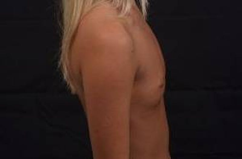 Breast Augmentation Silicone Gel Before & After Gallery - Patient 228658 - Image 5