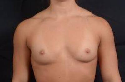 Breast Augmentation Silicone Gel Before & After Gallery - Patient 875748 - Image 1