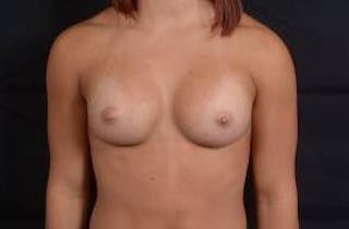 Breast Augmentation Silicone Gel Before & After Gallery - Patient 875748 - Image 2