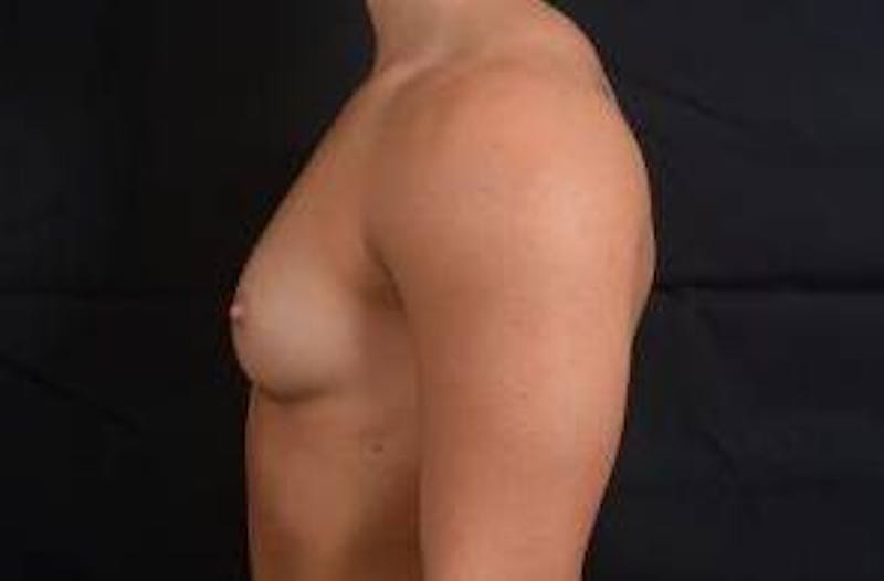 Breast Augmentation Silicone Gel Before & After Gallery - Patient 875748 - Image 3