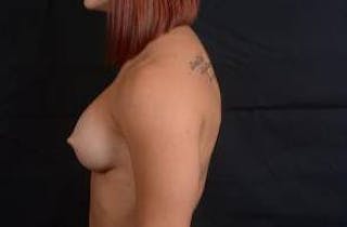 Breast Augmentation Silicone Gel Before & After Gallery - Patient 875748 - Image 4