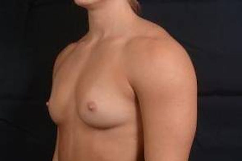 Breast Augmentation Silicone Gel Before & After Gallery - Patient 875748 - Image 7
