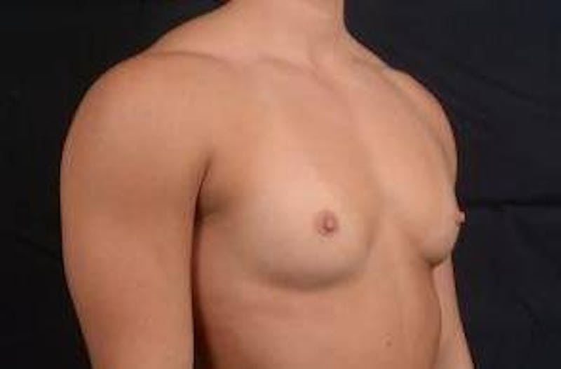 Breast Augmentation Silicone Gel Before & After Gallery - Patient 875748 - Image 9