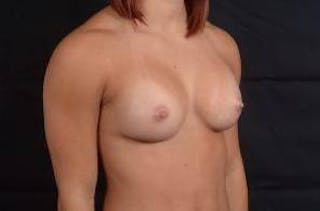 Breast Augmentation Silicone Gel Before & After Gallery - Patient 875748 - Image 10