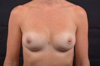 Breast Augmentation Silicone Gel Before & After Gallery - Patient 352802 - Image 2
