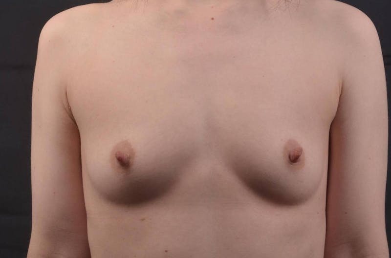 Breast Augmentation Silicone Gel Before & After Gallery - Patient 241237 - Image 1