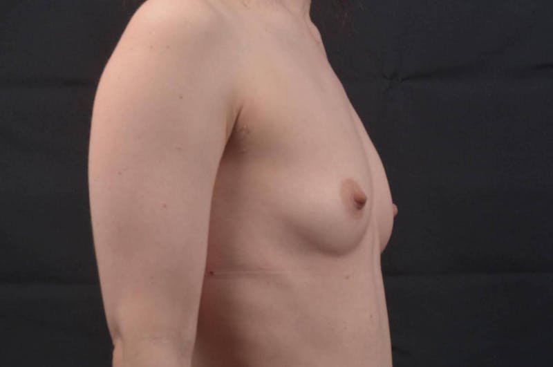 Breast Augmentation Silicone Gel Before & After Gallery - Patient 241237 - Image 5