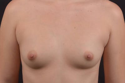 Breast Augmentation Silicone Gel Before & After Gallery - Patient 265563 - Image 1