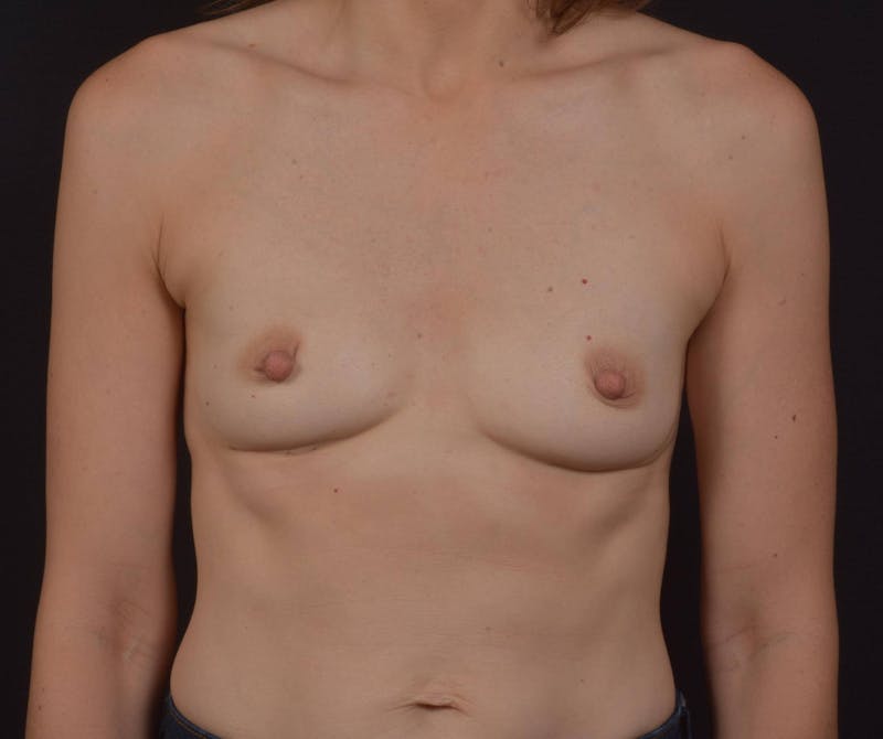 Breast Augmentation Silicone Gel Before & After Gallery - Patient 271490 - Image 1