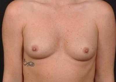 Breast Augmentation Silicone Gel Before & After Gallery - Patient 255945 - Image 1