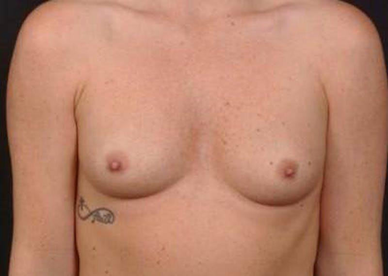 Breast Augmentation Silicone Gel Before & After Gallery - Patient 255945 - Image 1