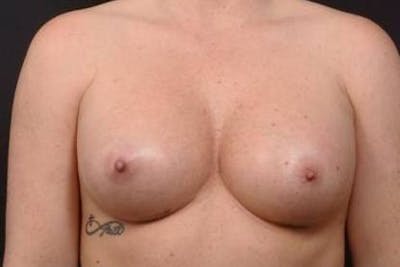 Breast Augmentation Silicone Gel Before & After Gallery - Patient 255945 - Image 2