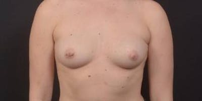 Breast Augmentation Silicone Gel Before & After Gallery - Patient 339085 - Image 1