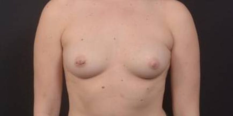 Breast Augmentation Silicone Gel Before & After Gallery - Patient 339085 - Image 1