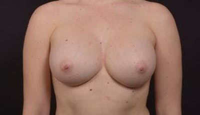 Breast Augmentation Silicone Gel Before & After Gallery - Patient 339085 - Image 2